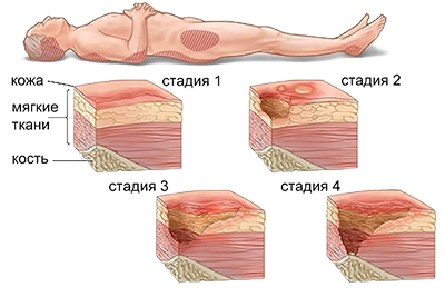 Стадии развития пролежней